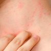 Cuida tu piel de la dermatitis atópica