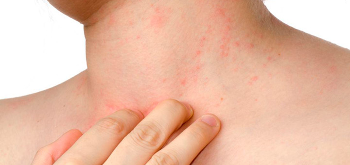 Cuida tu piel de la dermatitis atópica